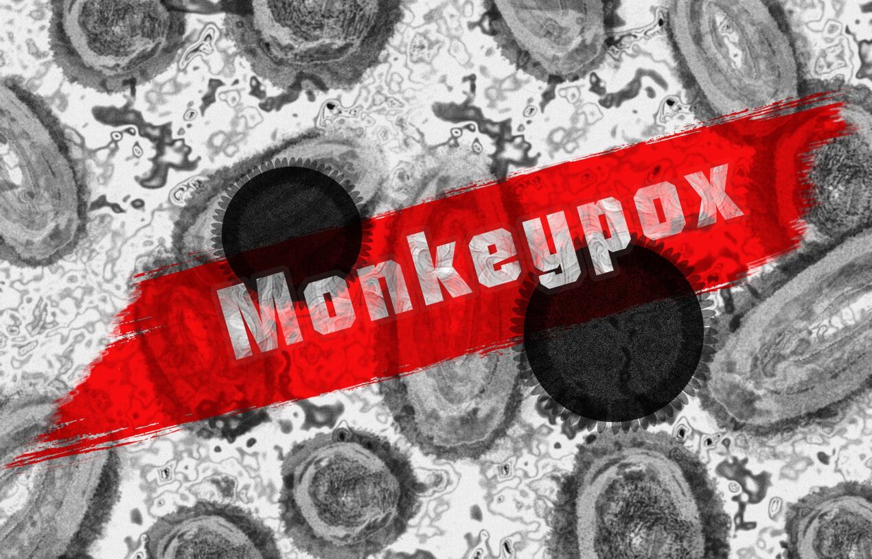 Monkeypox Is a Sexually Transmitted Infection? Let’s find out